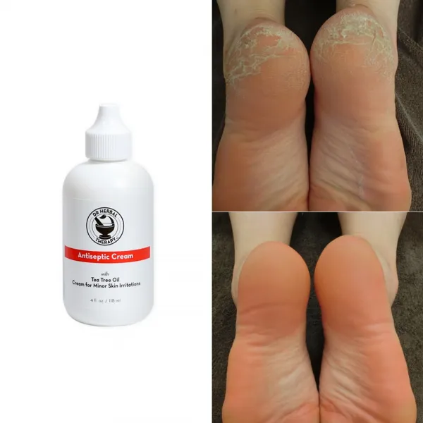 닥터허벌테라피 크림 손 발 무좀 발가락 사이 습진 각화형 발톱 발바닥 엄지 냄새 약 연고
