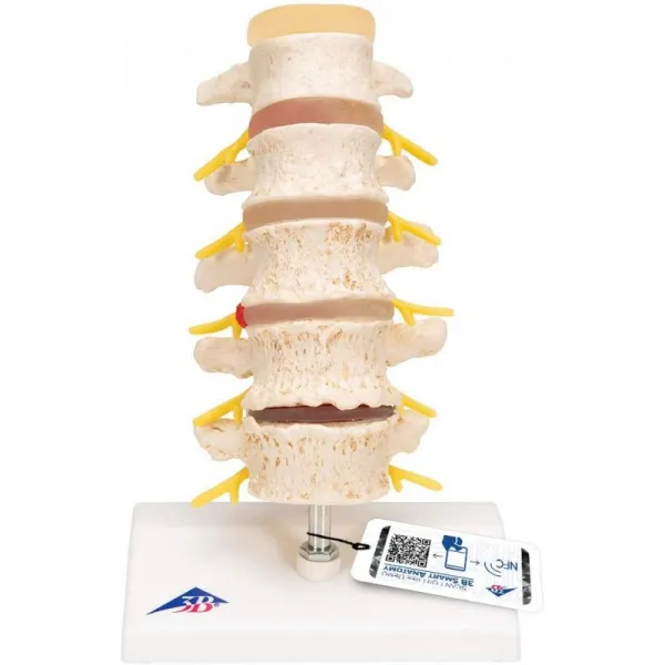 디스크 탈출증과 척추 퇴행의 3B 과학 단계 + 무료 해부 소프트웨어-3B Smart Anatomy