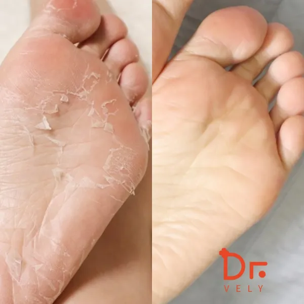 닥터블리 발각질제거 팩 발바닥 뒤꿈치 각질제거 풋케어 마스크, 1개입