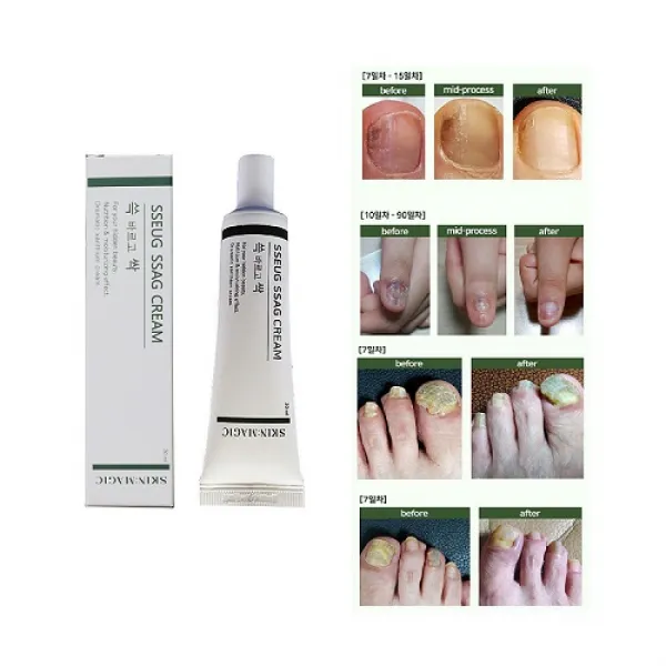 특허물질 도꼬마리 쓱싹크림 손발톱케어 30mL