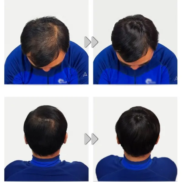 남자 정수리 뒤통수가발 덮어 헤어피스 부분가발 인모피스, 1개, 내츄럴브라운