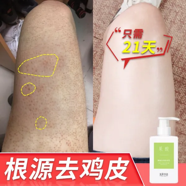 마린 시 윤 과일 산 보 디 로션 닭 피부 모낭 각질 덩어리 허벅지 보습 보 디 로션 뱀가죽 잔병 학생 남녀 향 로션 300 ml 300 ml, 상세페이지 참조