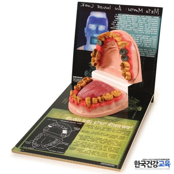 약물오남용교육-환각제(각성제)남용자의 구강모형 학교 보건수업용품