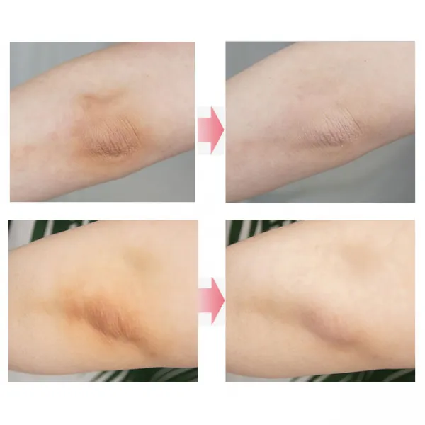 그랏사 겨드랑이 팔꿈치 와이존 엉덩이 비키니라인 피부 색소침착 미백크림 바디크림, 1개, 50ml