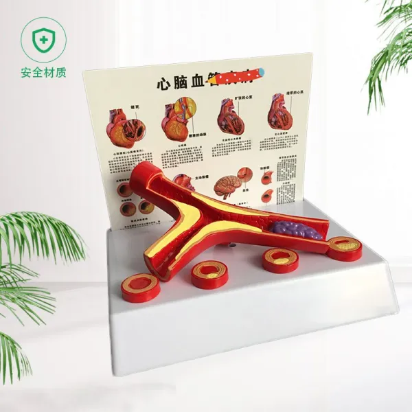 인체장기위치 사람내장구조 해부도 뼈구조 모형 인간 가지 죽상 경화증 11 심혈관 동맥 1 해부 혈전 혈관, 갈래 혈관