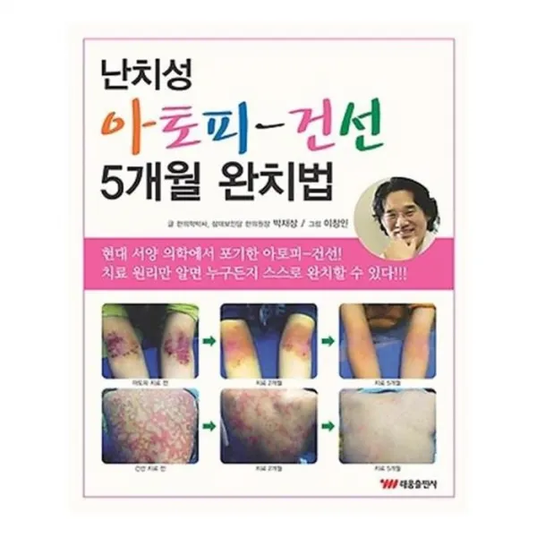 유니오니아시아 난치성 아토피 건선 5개월 완치법