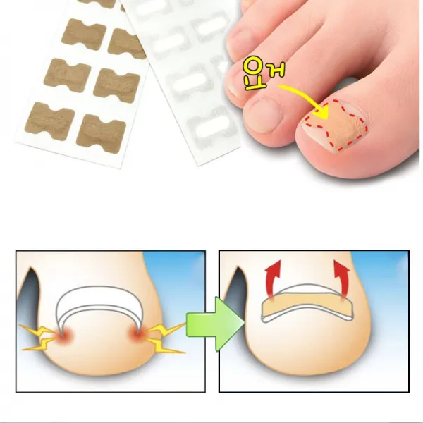 HEALTH 내성 발톱 교정 테이프 파고드는 내향성 TAPE, 단품, 단품