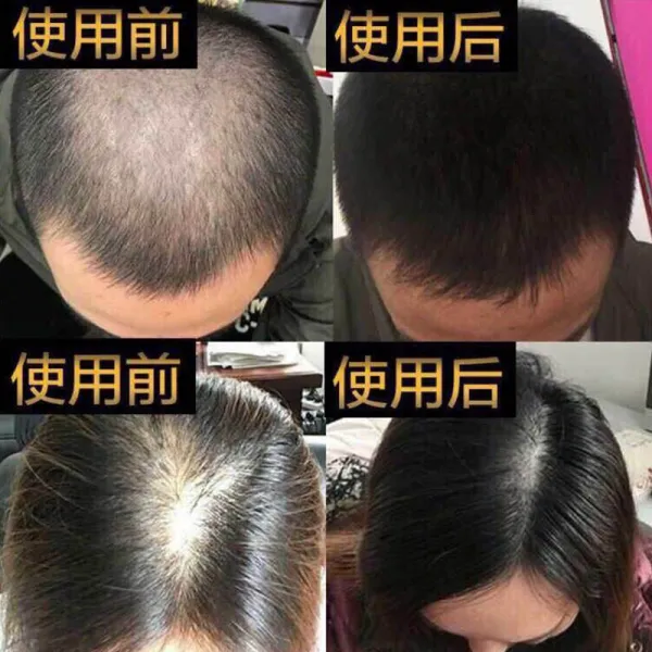 생모액 탈모 방지 대머리 머리카락 증발 정화 증발 밀발 발육 남녀 지일성 머리카락 보호 및 고발 영양제1병/(생발 2개 사면 1개 행사