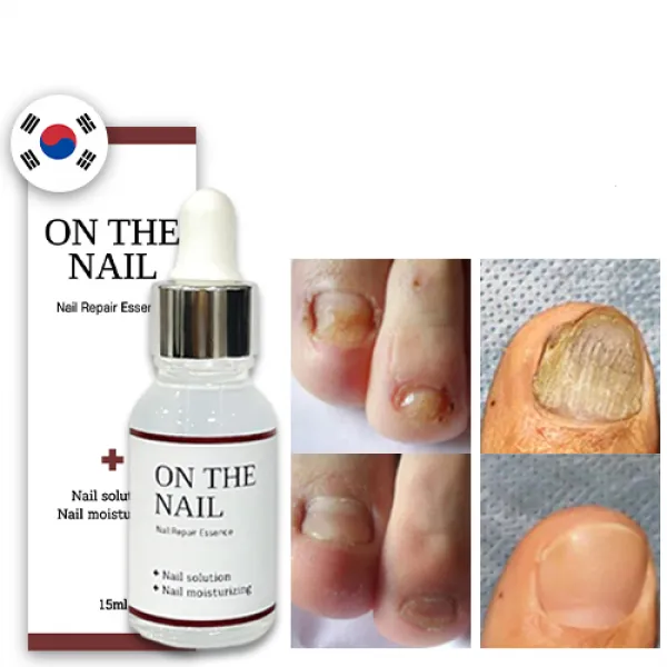 명품 온더네일 에센스 네일 트리트먼트 손발톱 강화 곰팡이균 무좀 변색 젤네일시술로 인한 손톱 발톱 손상 리페어 에센스 nail repair nail fungus treatment, 15ml, 1개