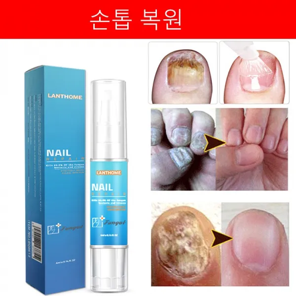 항진균 손톱치료 펜 손톱복구 면봉을 증정하다 경품 면봉, 2개